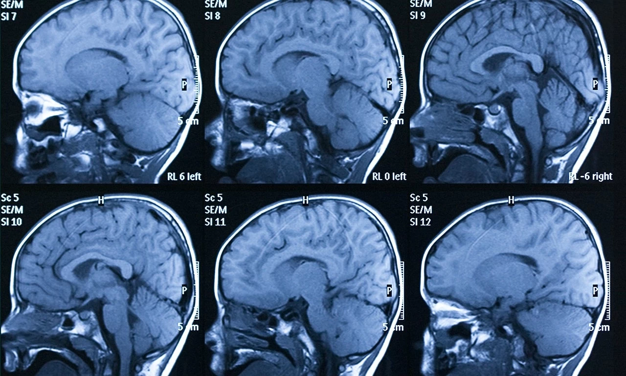 Η τεχνητή νοημοσύνη εντοπίζει τις εγκεφαλικές αιμορραγίες – Μεγάλη βοήθεια για τους ακτινολόγους